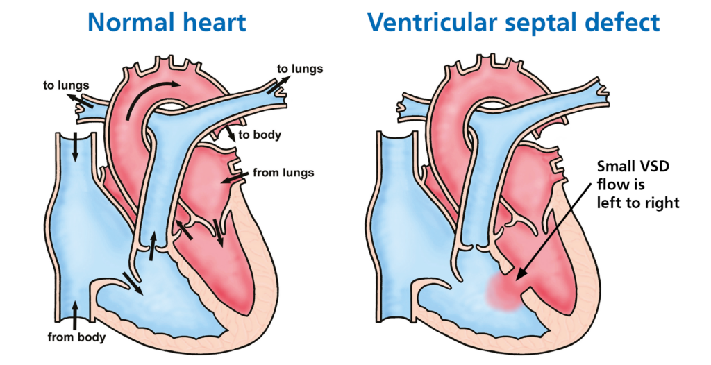Picture shows a normal heart on the left and a heart with a ventricular septal defect on the right 
