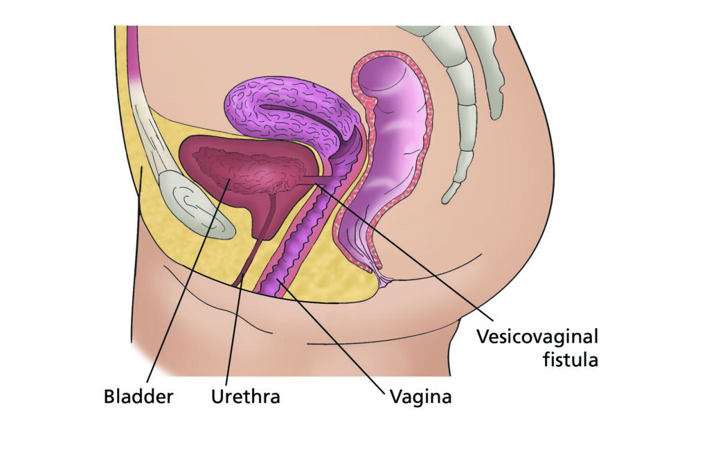 A diagram showing side view of pelvis and labelled bladder, urethra, vagina and vesicovaginal fistula.