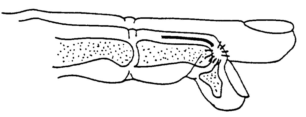 Image showing a tear in the tendon.