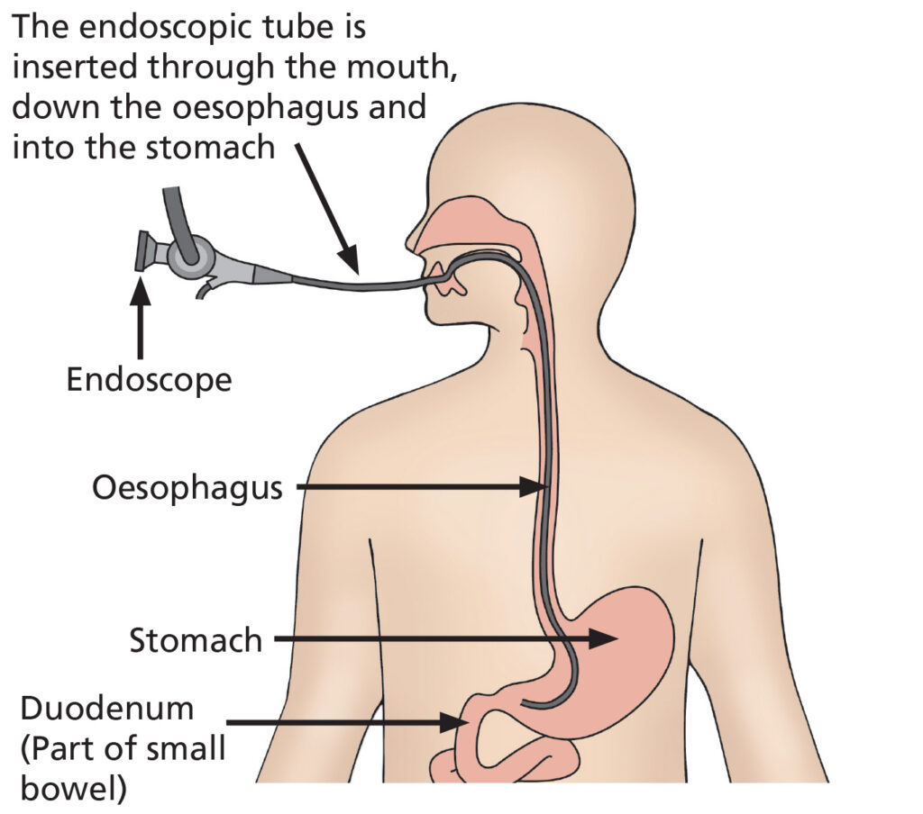 Illustration of a Gastroscopy, showng the endoscopic tube beng inserted through the mouth, down the oesophagus and into the stomach.



A Gastroscopy is a safe, minimally invasive procedure. A Endoscopist passes a thin flexible tube with a camera&nbsp; used to examine the lining of the throat, Oesophagus, stomach and small intestine (duodenum).