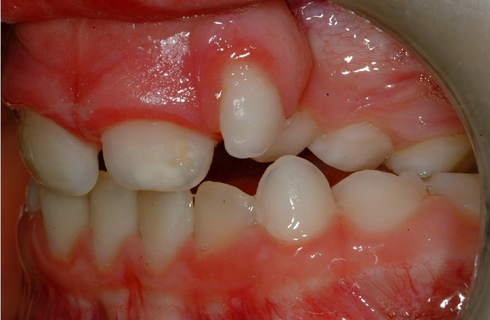Close up picture of child's teeth showing cleft in the gum.