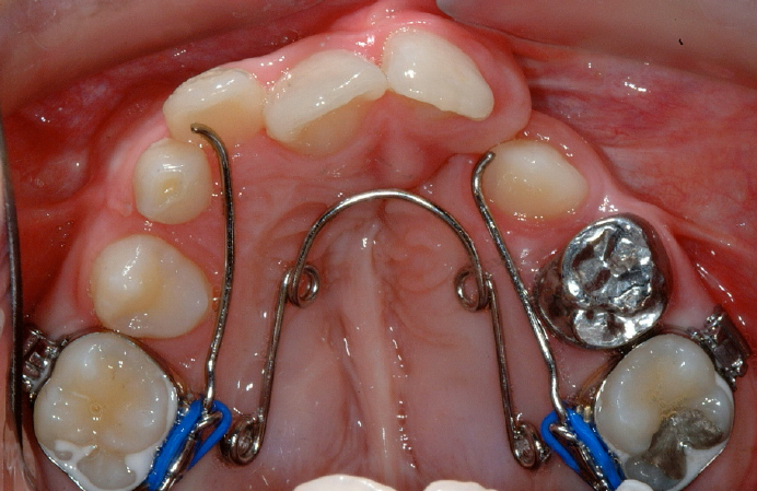 Image of orthodontic brace in the roof of a child's mouth.