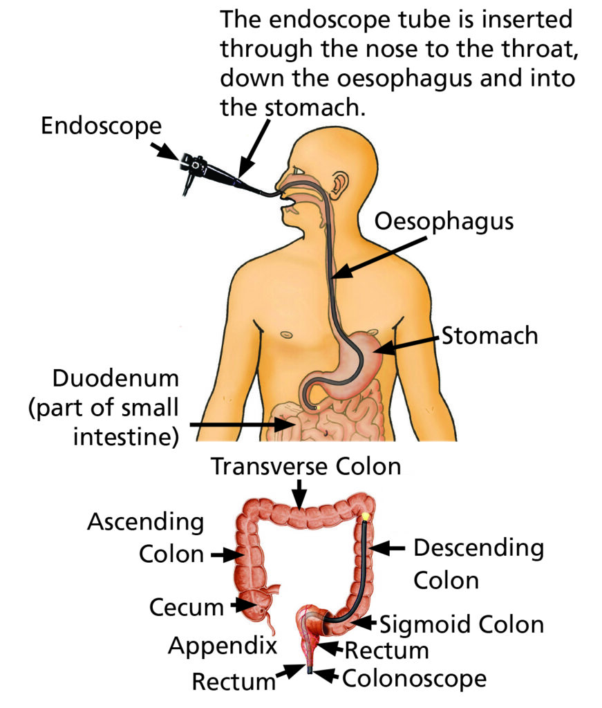 Illustration of an endoscope tube being inserted through the nose to the throat down the oesophagus and into the stomach. An endoscope is a small flexible tube with a camera on the end and is the width of a pencil. It is inserted through the nose down your throat, oesophagus and stomach then to your Duodenum a part of small intestine.



A section of the illustration also shows a camera being passed through the large bowel and into the small intestine (similar to a colonoscopy).