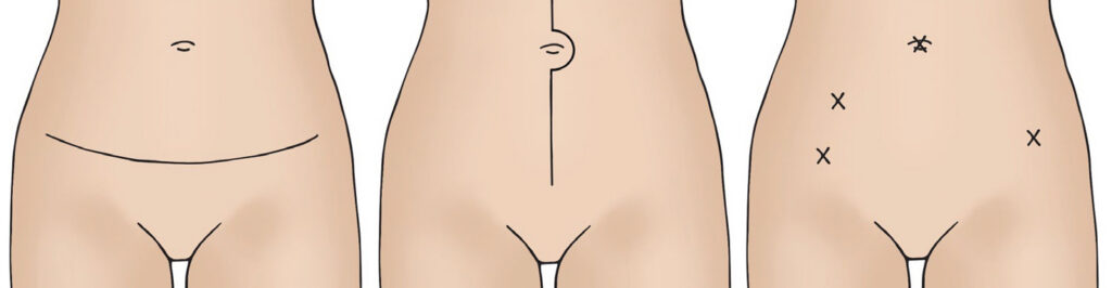 Three illustrations;
Left illustration shows a horizontal 'bikini line' incision in abdomen.
Middle illustration shows a vertical incision in abdomen from just above belly button down to pubic area.
Right illustration shows four little crosses on abdomen to show where laparoscopic and robotic incisions are made.