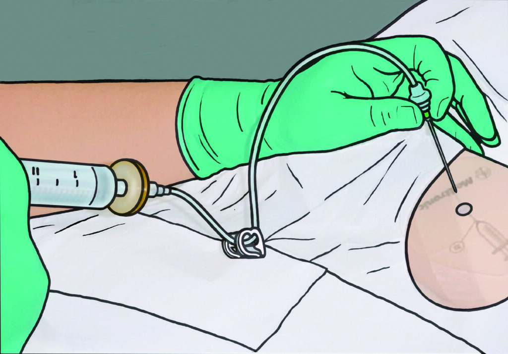 Image showing the refill procedure.