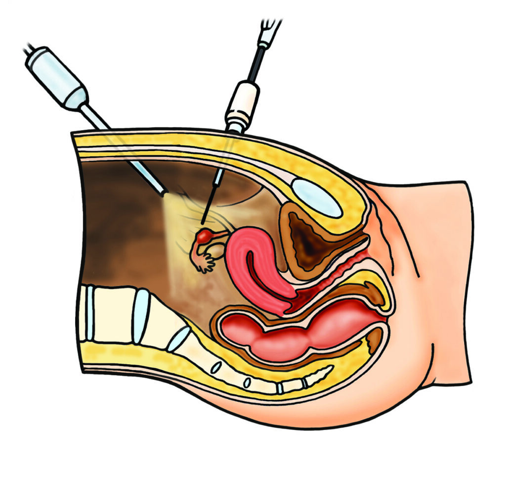 An illustration showing a cut-away drawing of the belly with the keyhole instruments in position.