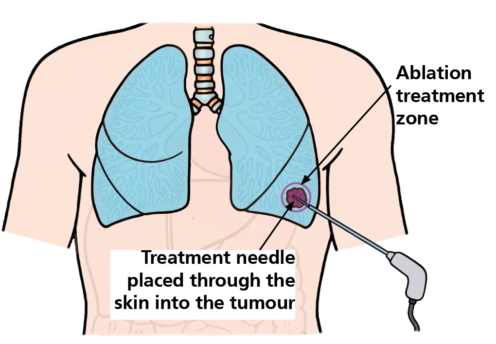Picture showing the ablation zone in the lung and the treatment needle placed through the skin into the tumour.