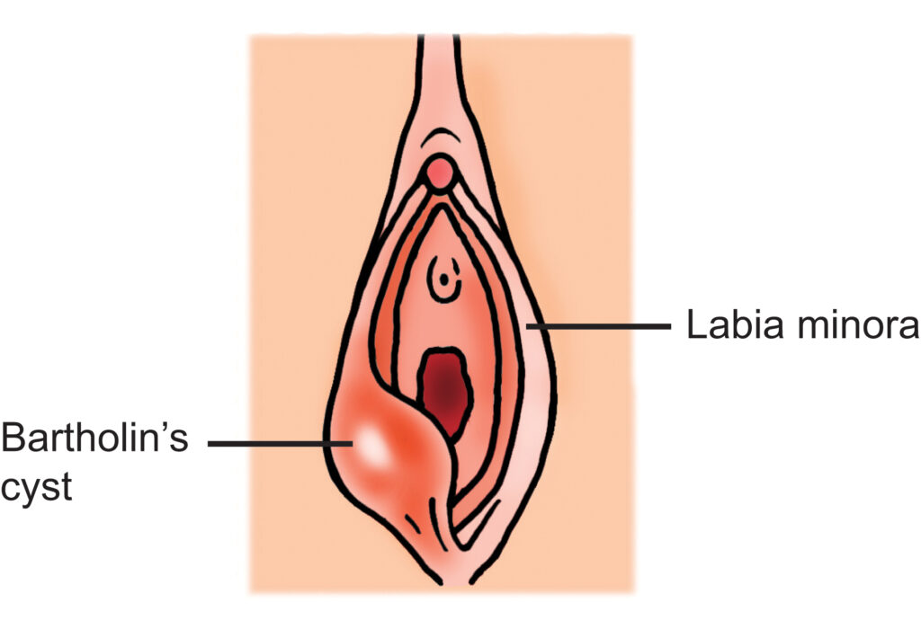 An illustration that shows a Bartholin's cyst and the Labia minora.