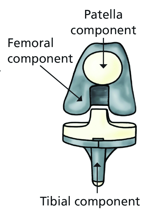 Illustration showing the components of a knee replacement. (Patella component, Femoral component and the Tibial component)