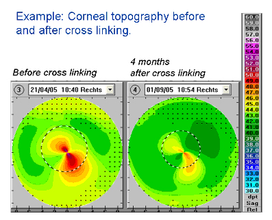 An image showing a corneal topography before and after cross linking.