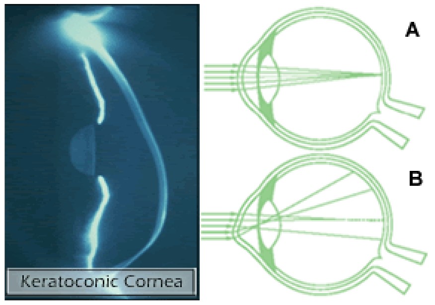 An image showing how Keratoconus causes distorted vision.