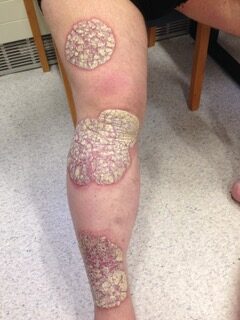 Overview photo of a rash