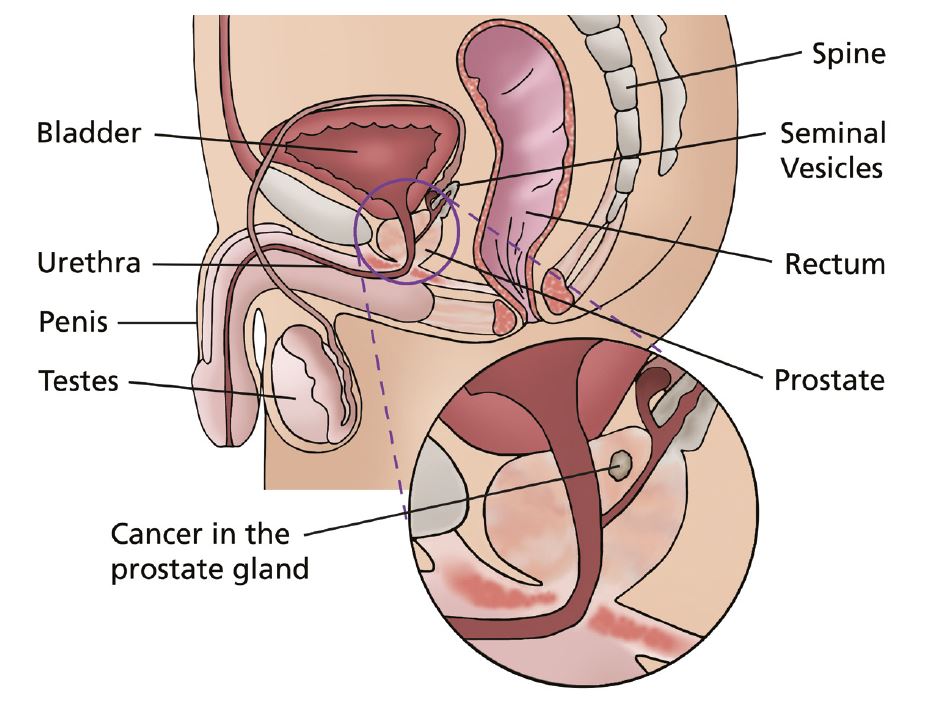 A labelled image showing the lower half of a male body with magnified section to show an example of cancer growth in the prostate gland.