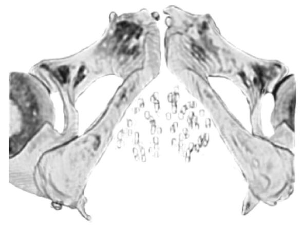 An image of a CT scan showing the seeds in the prostate.