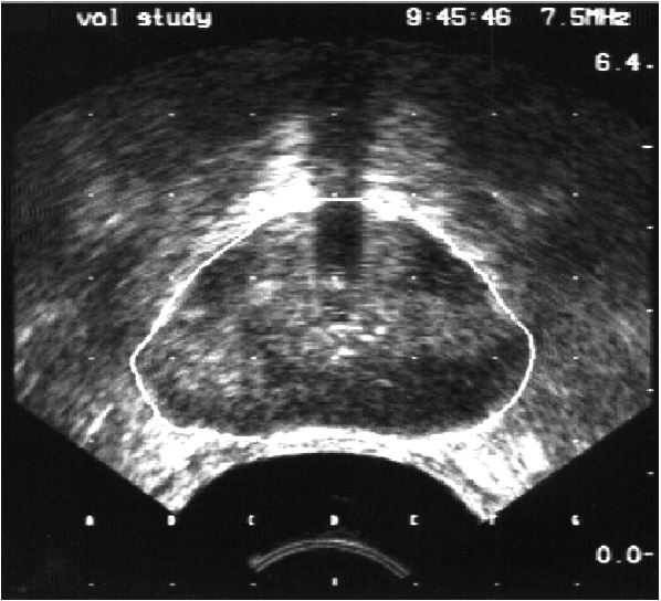 An ultrasound image of a rectum.