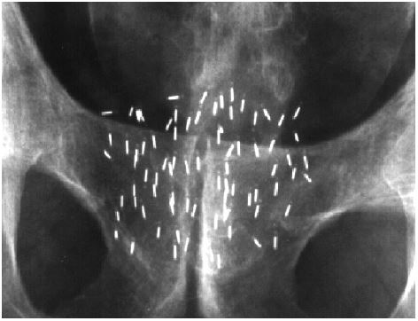 An image of a X-ray showing the position of the implanted seeds in the prostate gland.