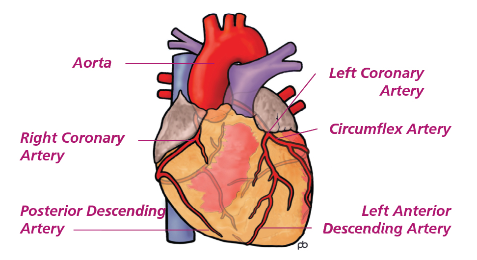 Illustration of the heart with labels to the aorta, right and left coronary artery, circumflex artery, posterior descending artery and left anterior descending artery