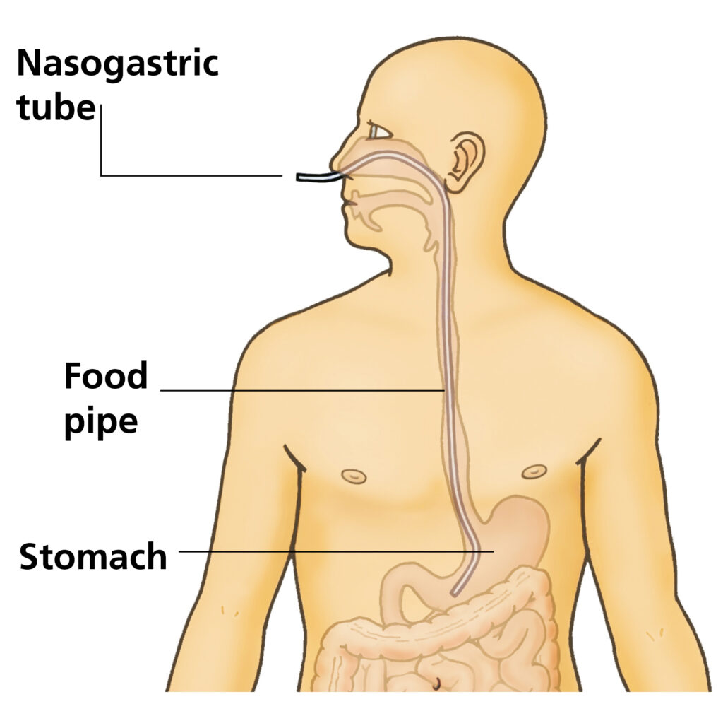 This picture shows a cross section of the body showing a nasogastric tube going from the nose down into the stomach.