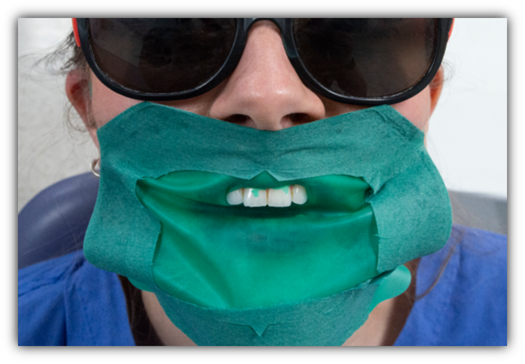 This photograph shows a protective tooth cover
called a rubber dam