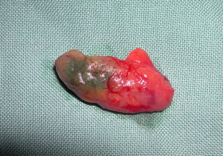 Photograph of a removed node with the blue dye colouring