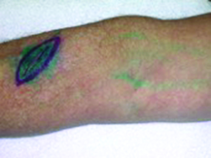Photograph of the skin marked up following scan