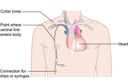 Diagram of Hickman Line