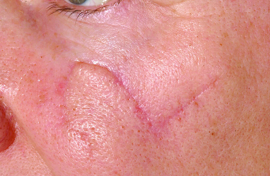 Photograph of a keloids scar 