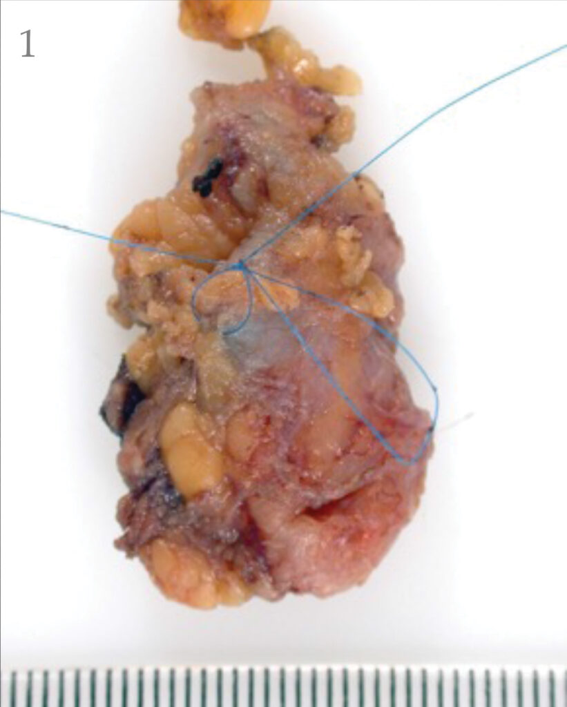 Sentinel node with radioactive hotspot marked