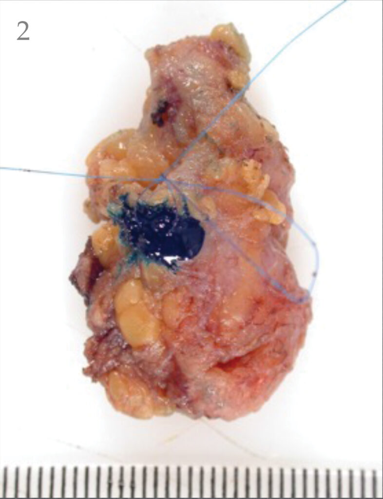 Sentinel node with hotspot inked.