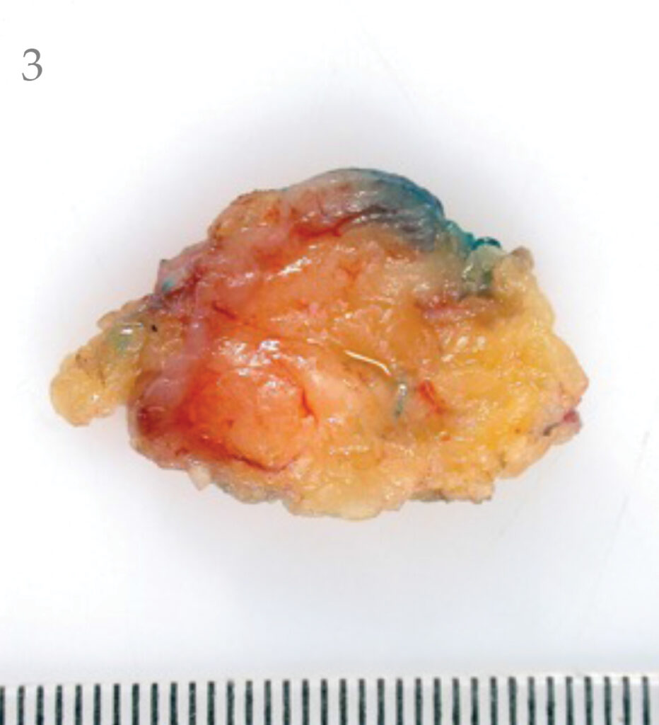 Sentinel node with hotspot ink visible.
