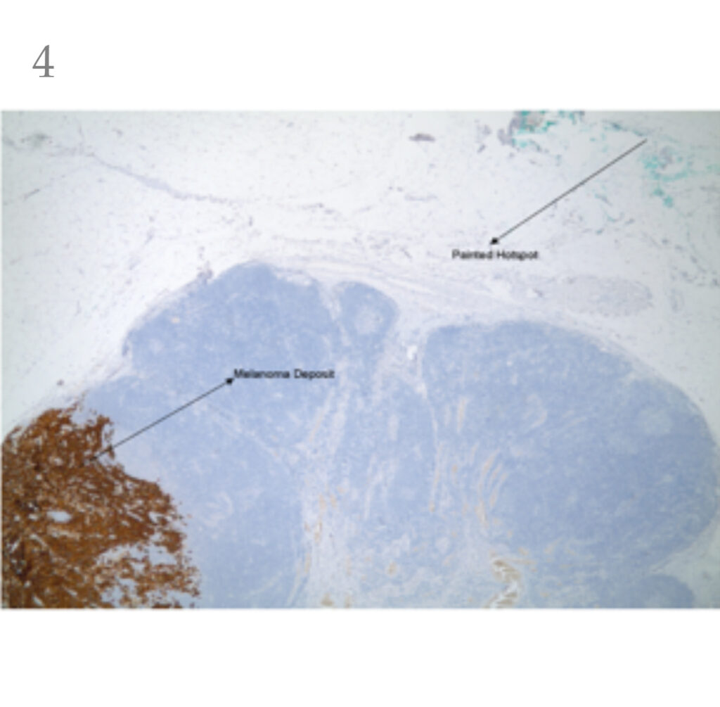 Sentinel node pathology with hotspot ink visible near the melanoma deposit in the node.