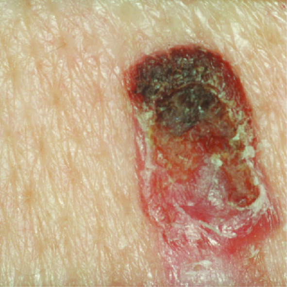 Photograph of a radial growth phase melanoma with irregular shape, mix of colour and dry apperance