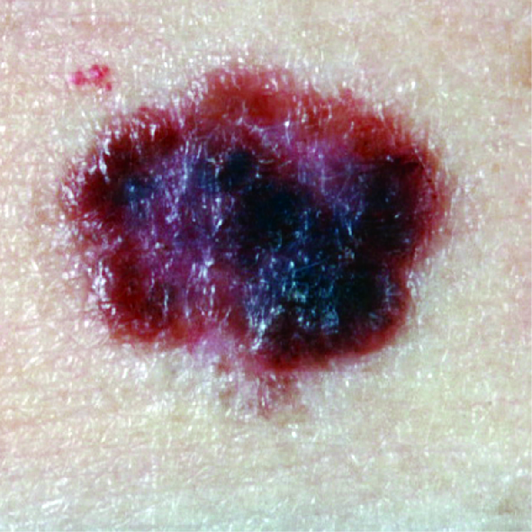 Photograph of a radial growth phase melanoma with irregular shape and mix of colour