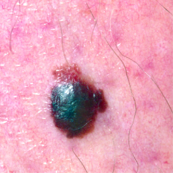 Photograph of a vertical growth melanoma 