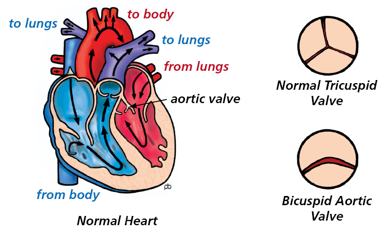 Illustration of a cross section of the heart showing the direction of blood flow in a normal heart, a normal tricuspid valve and a bicuspid aortic valve
