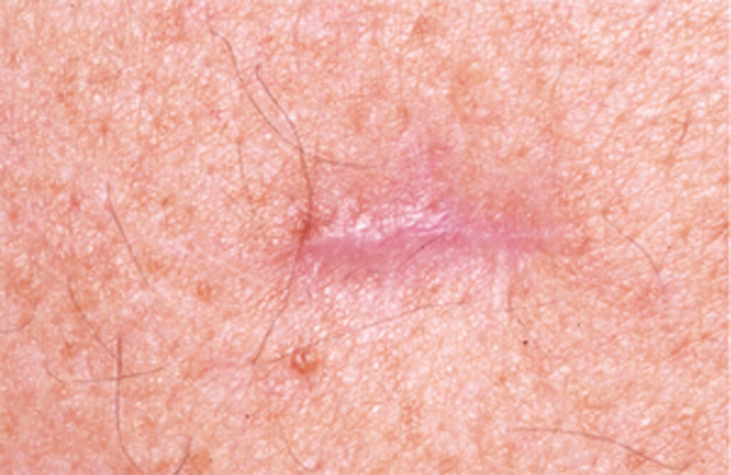 Photograph of a close up of a small scar on the skin