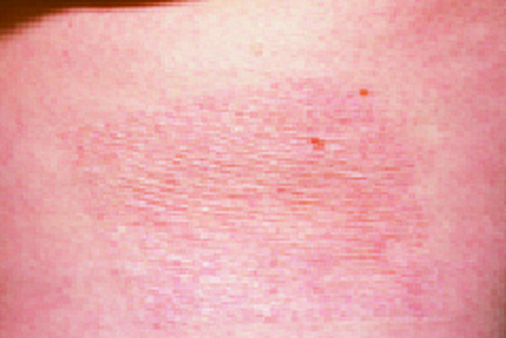 Photograph of a heald donor site with slight discolouration to the skin