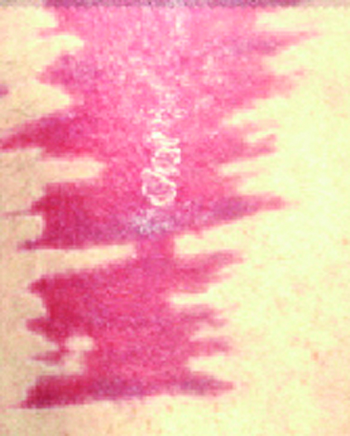 Photograph of a healed donor site with discolouration to the skin