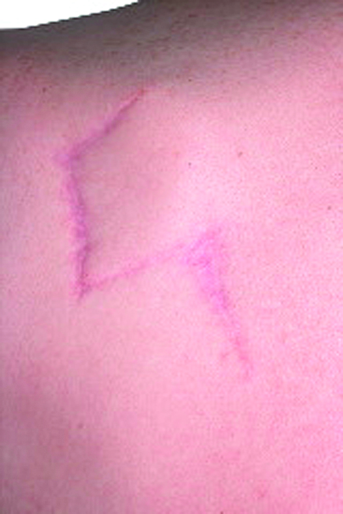 Photograph of a scar resulting from a flap