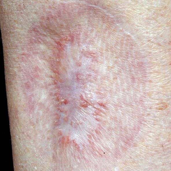 Photograph of an aged scar looking faded