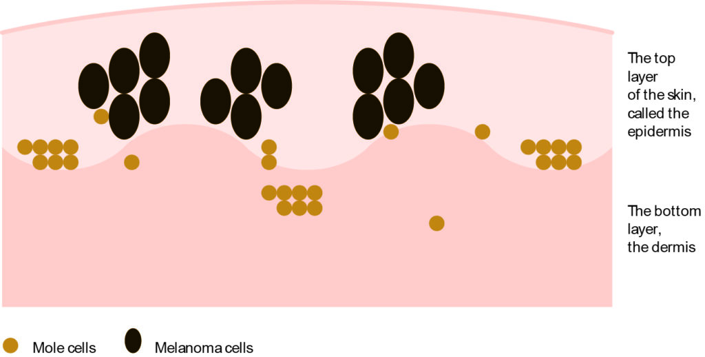 Illustration of the skin, showing the epidermis layer on top and the dermis layer underneath, with mole cells and melanoma cells