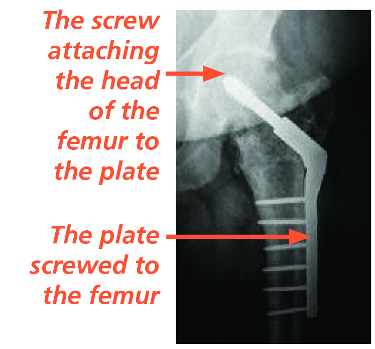 Image of an X-ray showing a metal plate and screws (known as a Dynamic Hip Screw).

An arrow shows the screw attaching the head of the femur to the plate.

Another arrow shows the plate screwed to the femur.