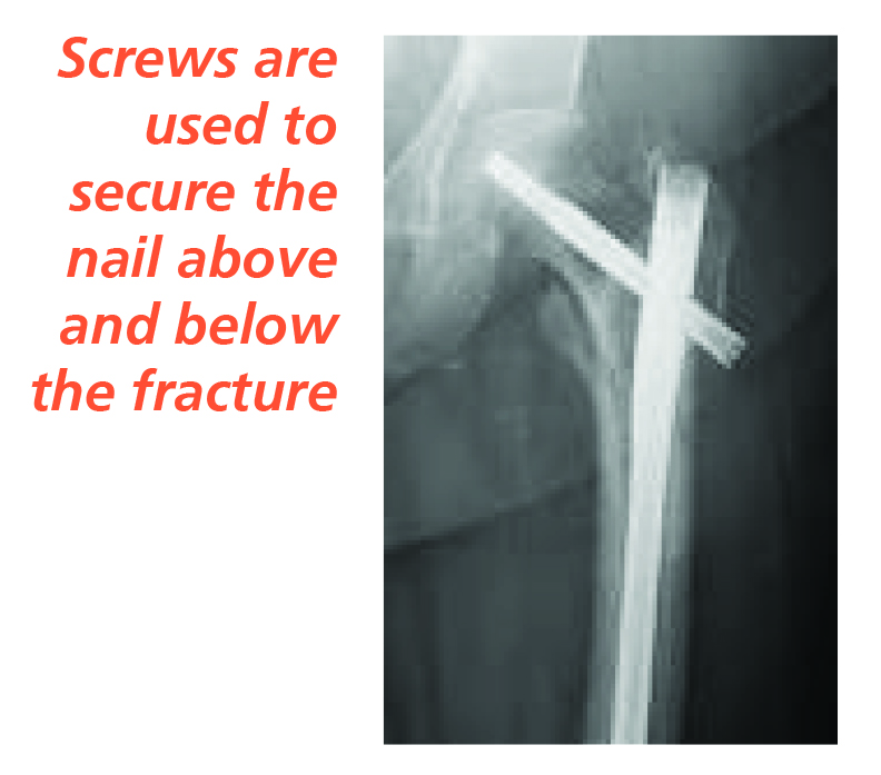 Image of an X-ray showing an Intramedullary (IM) nail.

Screws are used to secure the nail above and below the fracture.