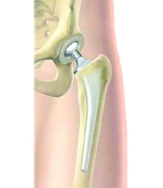 Image showing a total hip replacement.