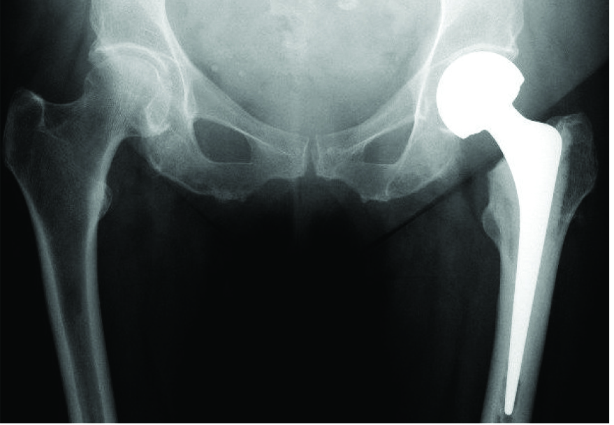 Image showing a partial hip replacement.