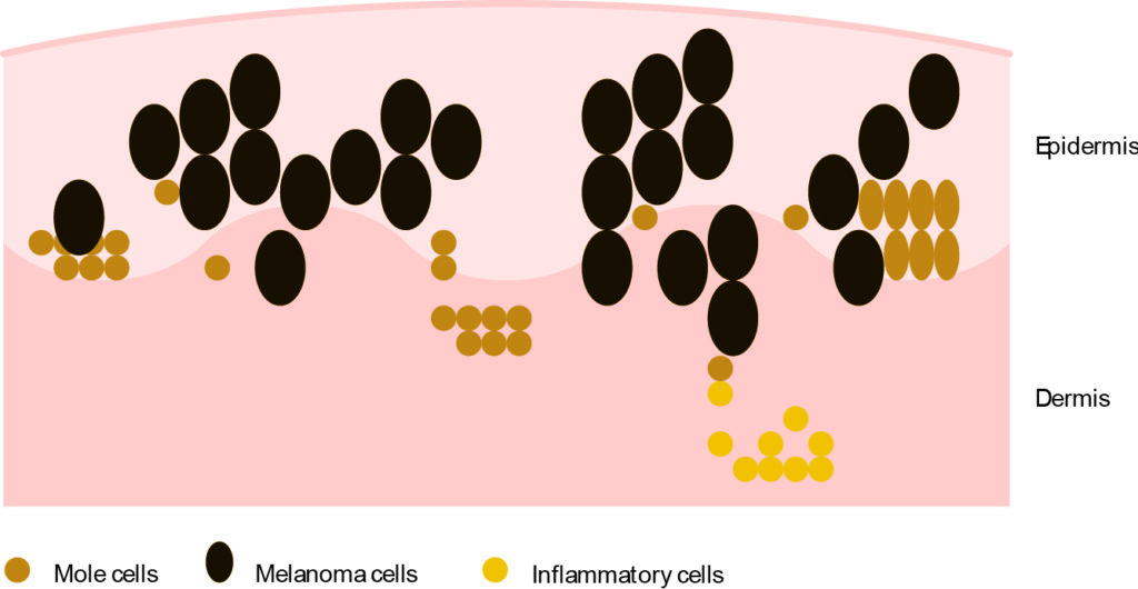 Illustration of the skin, showing the epidermis layer on top and the dermis layer underneath, with mole cells, melanoma cells and inflammatory cells