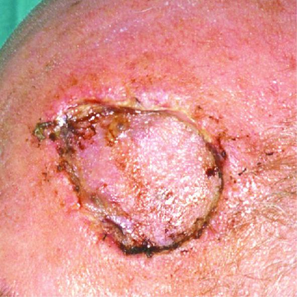 Photograph of an infected wound