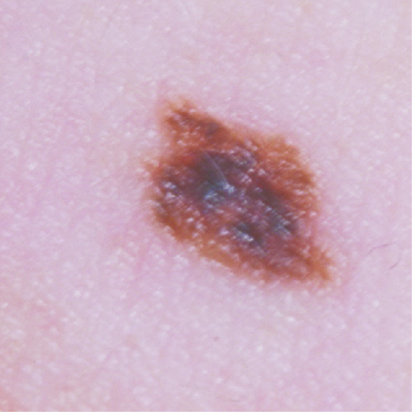Photograph of a melanoma with an irregular shape and colour