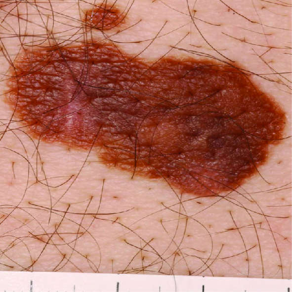 Photograph of a melanoma with irregular shape and dark colouring