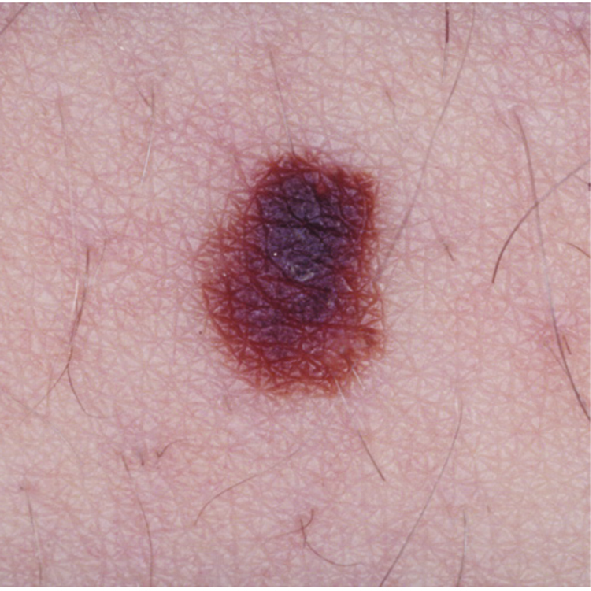 Photograph of small melanoma with dark colouring